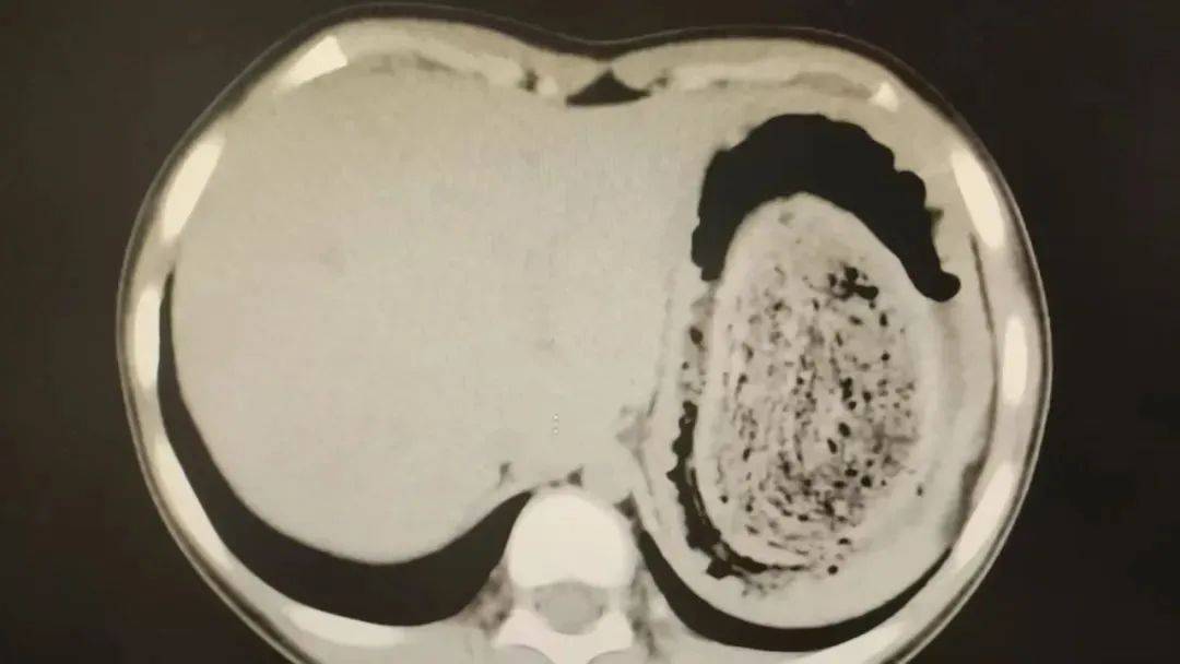 皇冠信用网账号申请_发现一例皇冠信用网账号申请,10岁女孩确诊!已有多起病例,有人因羞耻感延误就医